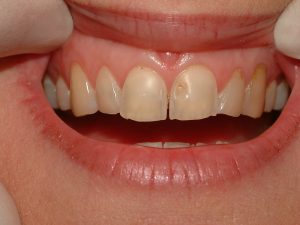 Image 2A 300x225 - How to improve your smile on a budget