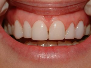 Image 2B 300x225 - How to improve your smile on a budget