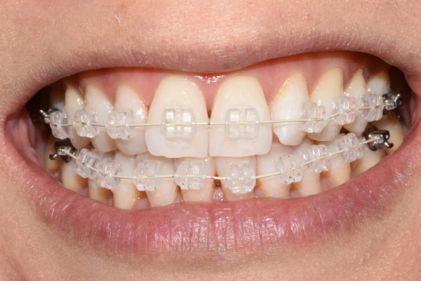 Journey to My Quick Straight Teeth | Oracle Dental Broadbeach