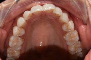Pre op12 300x200 - My Quick Straight Teeth Journey - Part 1