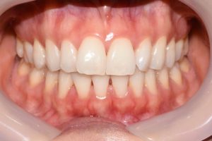 Pre op2 300x200 - My Quick Straight Teeth Journey - Part 1