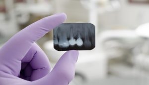 Oracle dental 300x172 - Why Dental X-rays?