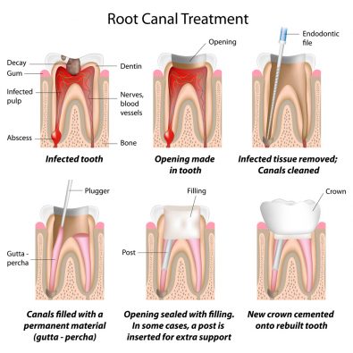 root canal highres2 395x395 - To root canal or not root canal? That is the question....