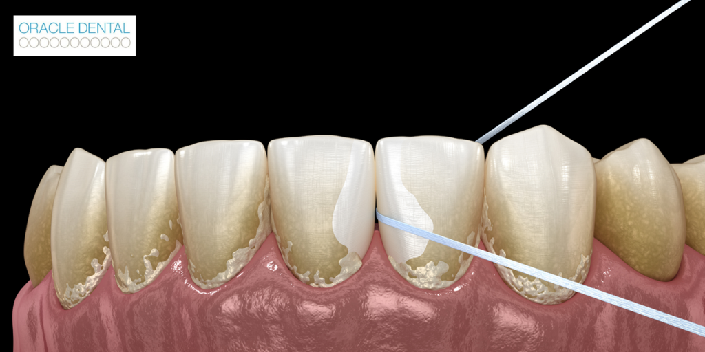 Best and Worst Foods for Your Teeth