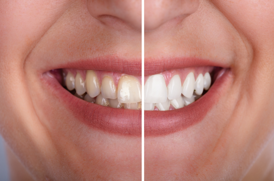 teeth whitening, teeth whitening gold coast, teeth whitening broadbeach, dentist gold coast, oracle dental broadbeach