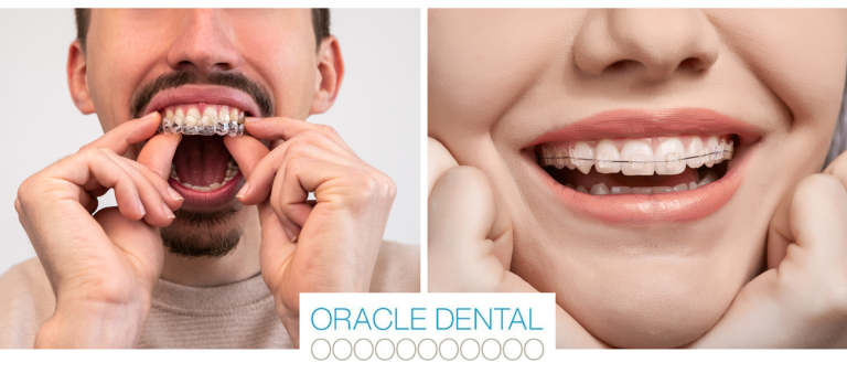 Invisalign vs Braces with Oracle Dental Broadbeach