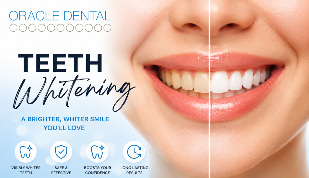 How Long Does Teeth Whitening Last by Oracle Dental Broadbeach