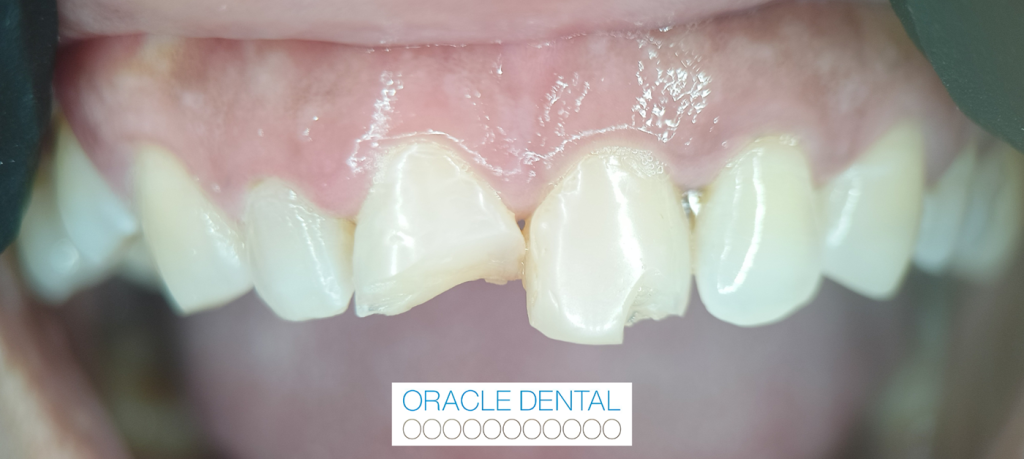 Cracked Tooth Emergency Dentist Gold Coast, Oracle Dental Broadbeach
